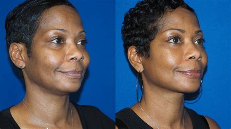 Vertical Vs Horizontal Facelift
