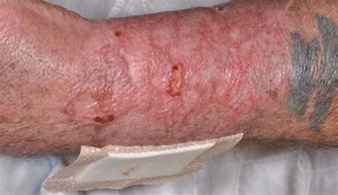 vibrio vulnificus wound infection