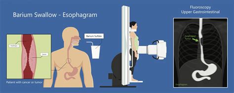 video esophagram vs barium swallow