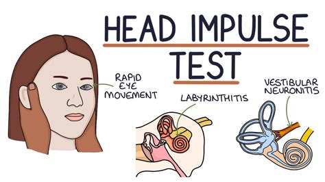 Video Head Impulse Test Codigo Tuss