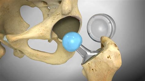 video hip replacement animation
