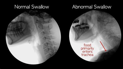 Video Of Normal Barium Swallow