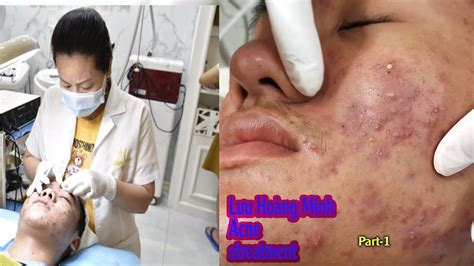 vietnamese acne spa videos