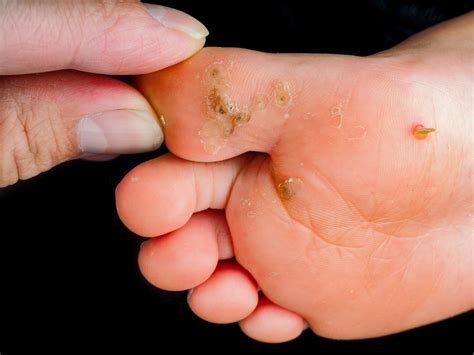 viral warts on feet