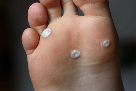 viral warts on foot