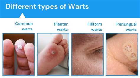 Uncovering the Virus of Warts: Understanding the Cause and Finding Effective Treatments