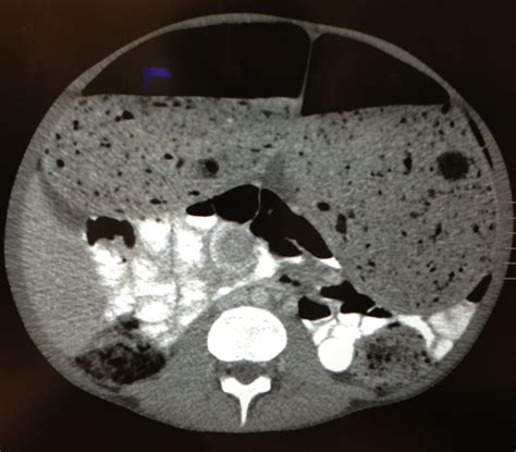 visible intestinal peristalsis may indicate: