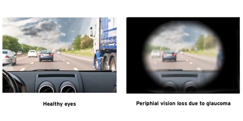 Vision Problems That Affect Driving