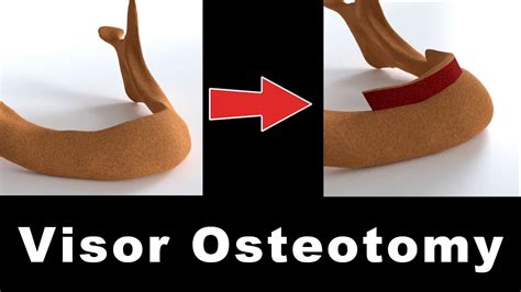 Visor Osteotomy Define