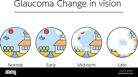 Visual Disturbances Glaucoma