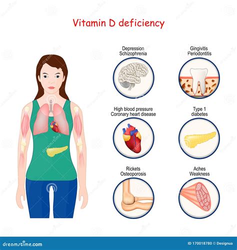 Vitamin D Deficiency Unspecified