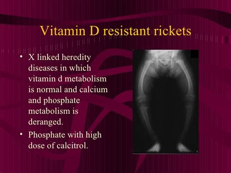 vitamin d resistant rickets icd 10