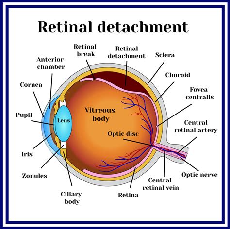 vitamins for retinal detachment