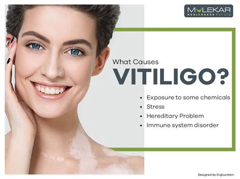 vitiligo causes and prevention