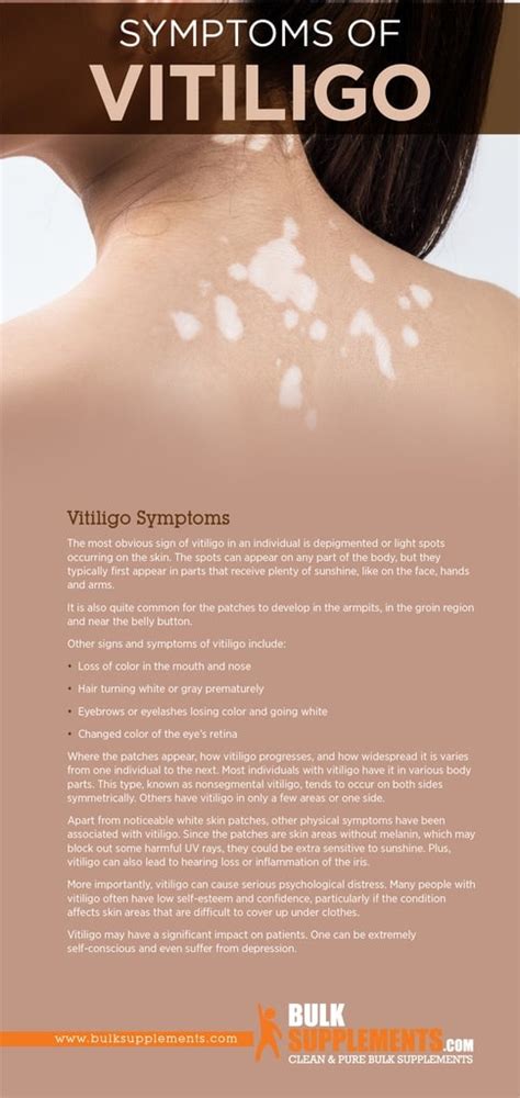vitiligo causes symptoms and treatments