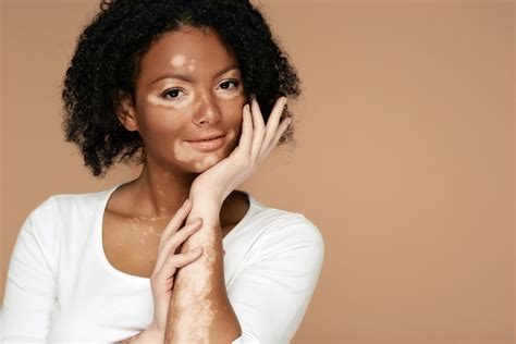 vitiligo images and pictures