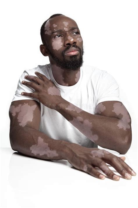 vitiligo in african americans