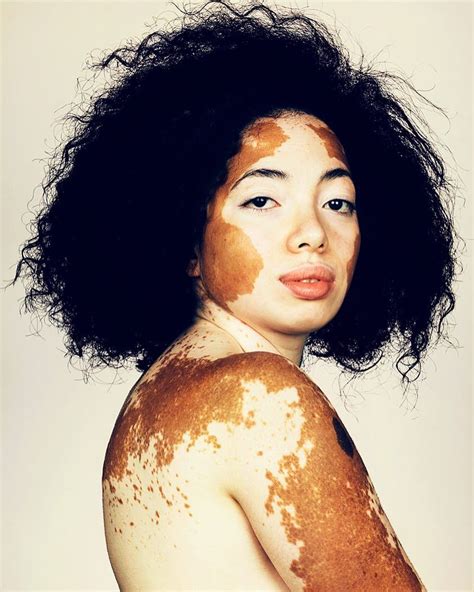 vitiligo nude