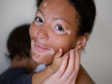 vitiligo porn