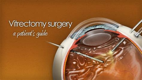 vitrectomy for floaters success rates
