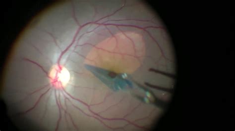 vitrectomy for macular hole