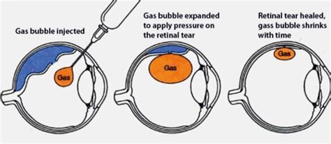 vitrectomy gas bubble dissipate