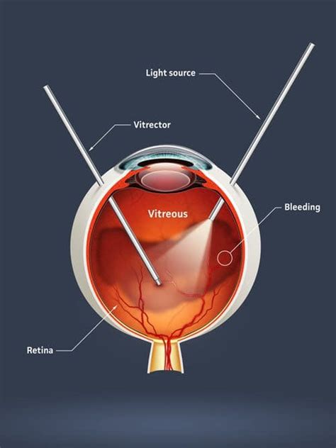 vitrectomy procedure cost