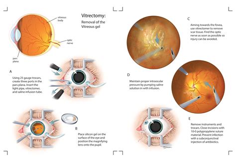 vitrectomy procedure steps