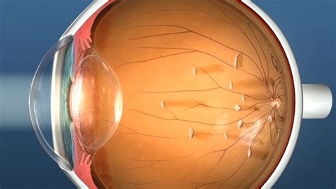 vitrectomy surgery to remove floaters