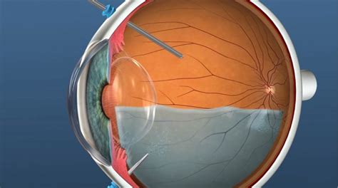 vitrectomy with air bubble