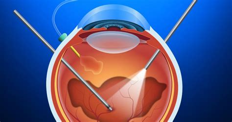 vitrectomy with endolaser cpt code