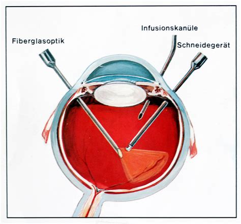 vitrektomie