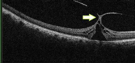 vitreomacular traction macular hole