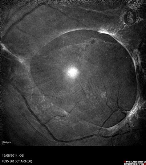 vitreomacular traction right eye icd 10