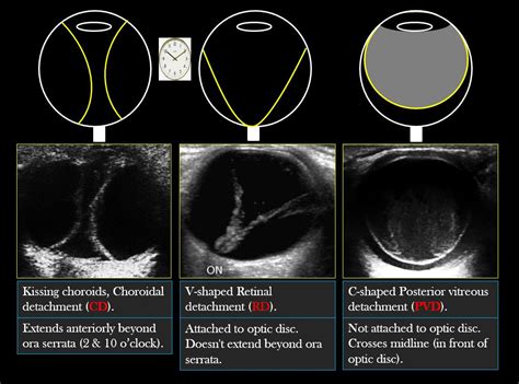 vitreous detachment vs retinal detachment
