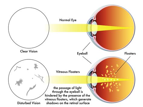 vitreous floaters of eye