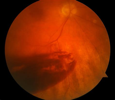 vitreous hemorrhage icd 10 left eye