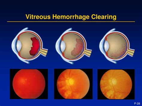 vitreous hemorrhage treatment