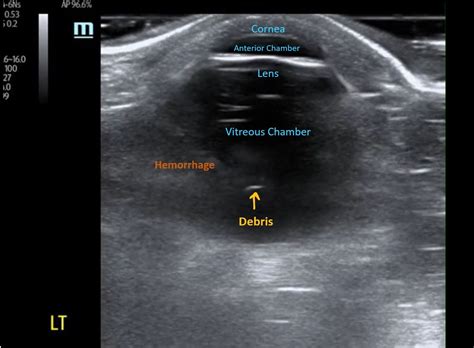 vitreous hemorrhage ultrasound