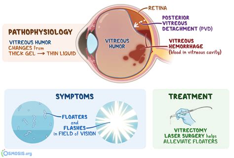 vitreous hemorrhage vs vitreous detachment