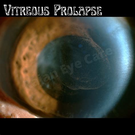 vitreous prolapse eye