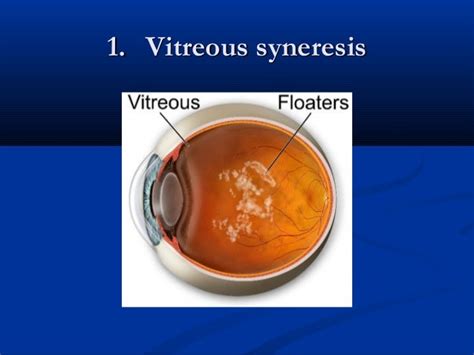 vitreous syneresis meaning