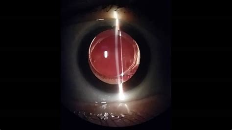 vitreous syneresis of both eyes