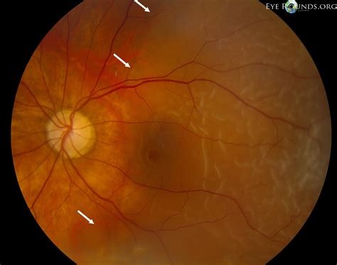 vitreous syneresis of left eye