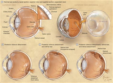 vitreous vs retinal detachment