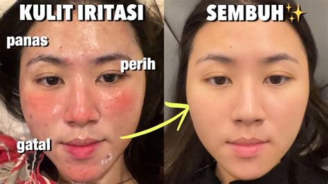 wajah iritasi merah dan gatal di Indonesia