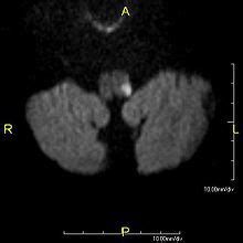 wallenberg syndrom icd 10