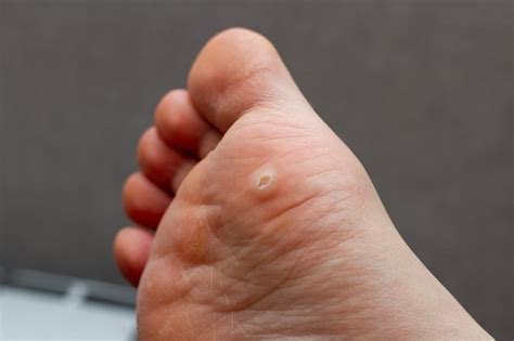 home.furnitureanddecorny.com:wart on foot painful
