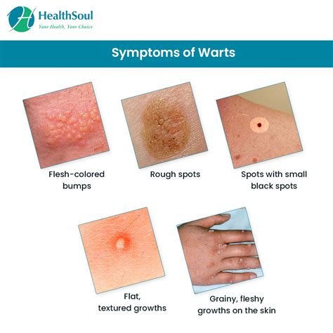 warts and other skin growths
