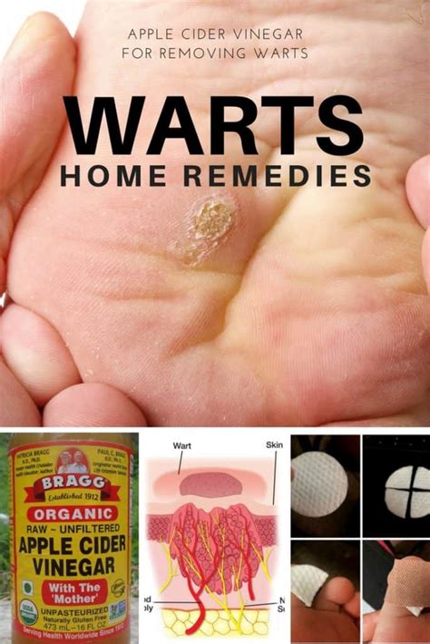 warts apple cider vinegar cure